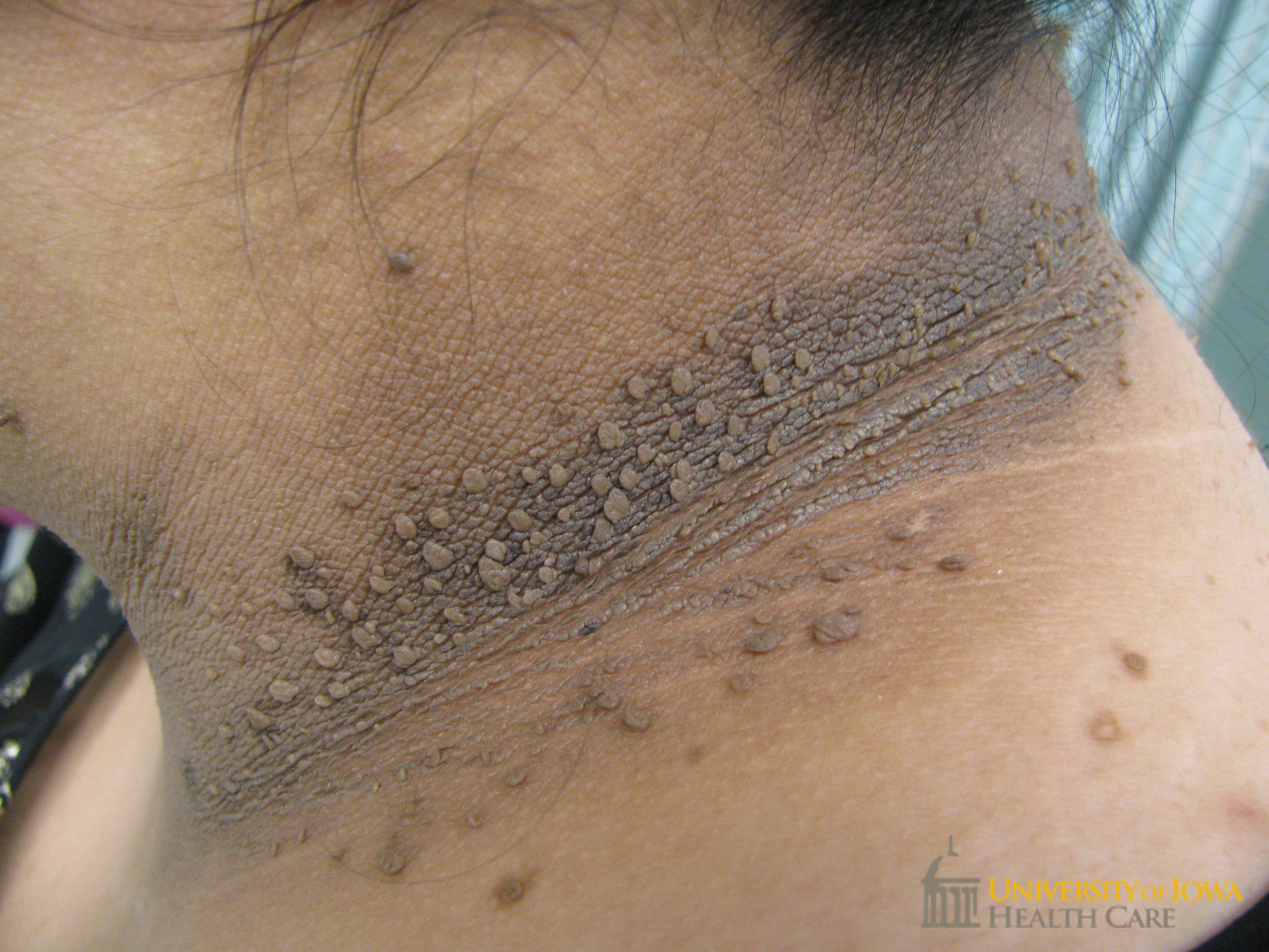 Gray velvety plaques with overlying pedunculated papules on the neck. (click images for higher resolution).